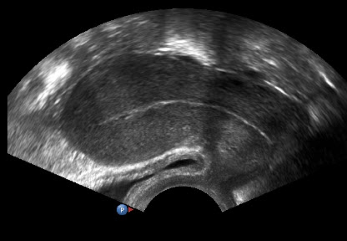 Beeld van een echografie van de baarmoeder.