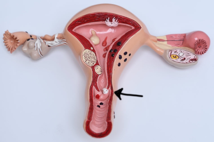 Een model van de vrouwelijke voortplantingsorganen. Het pijltje wijst naar een afwijking in de baarmoederhals.