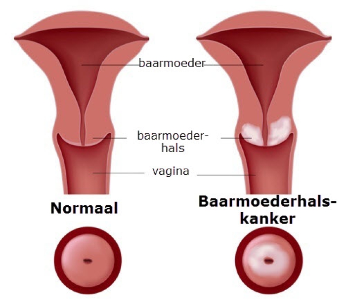 Baarmoederhalskanker ontstaat uit afwijkende cellen in het slijmvlies op de grens van de baarmoederhals en de baarmoedermond.