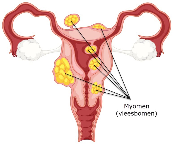 Grafische afbeelding van de baarmoeder met eileiders, eierstokken, baarmoederhals en vagina. 