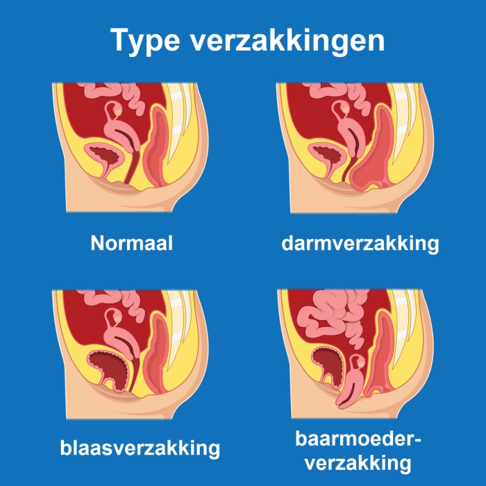Op de afbeeldingen is te zien wat er gebeurt bij een verzakking van de darm, blaas en baarmoeder. 